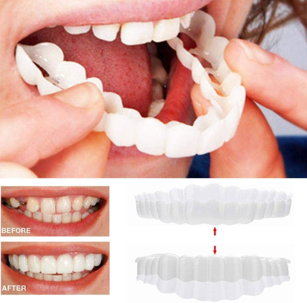 Facettes Dentaires Amovibles pour Un Sourire Parfait 0