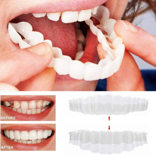 Facettes Dentaires Amovibles pour Un Sourire Parfait 0