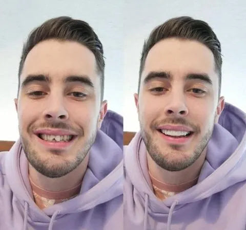 Facettes Dentaires Amovibles pour Un Sourire Parfait 2