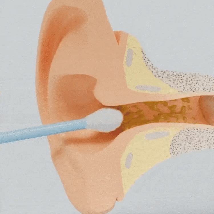 Outil de Nettoyage des Oreilles Innovant 2