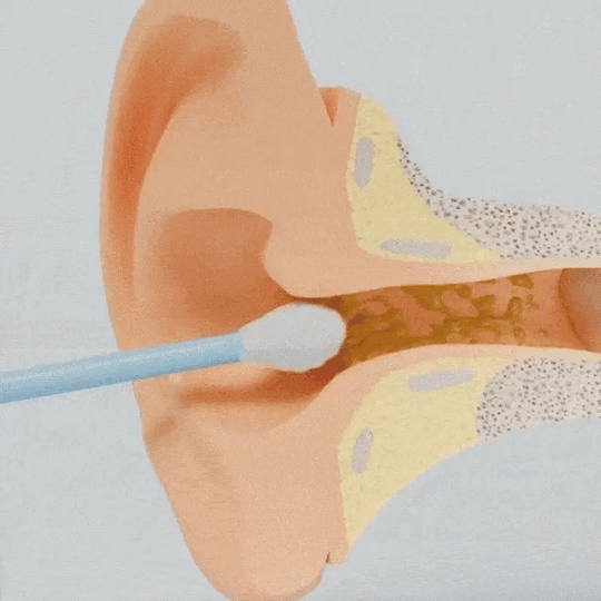 Outil de Nettoyage des Oreilles Innovant 2