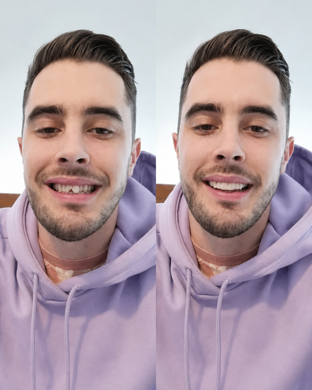Facettes Dentaires Amovibles pour Un Sourire Parfait